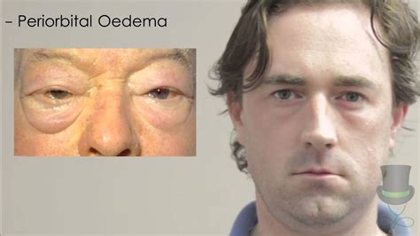 Periorbital Edema Hypothyroidism