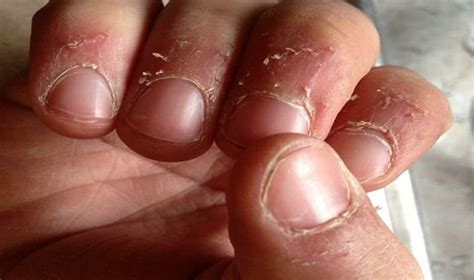 sore rough thick peeling dry skin  nails  skincarederm