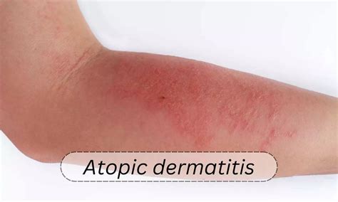 management  atopic dermatitis  topical therapies  adults