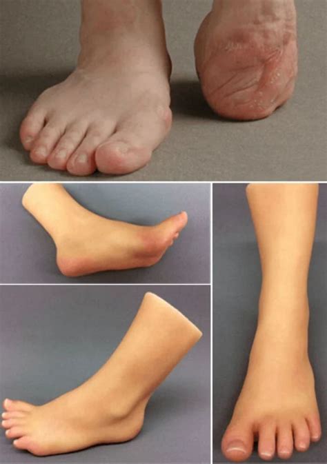 limb partial foot prosthesis   knee  piece