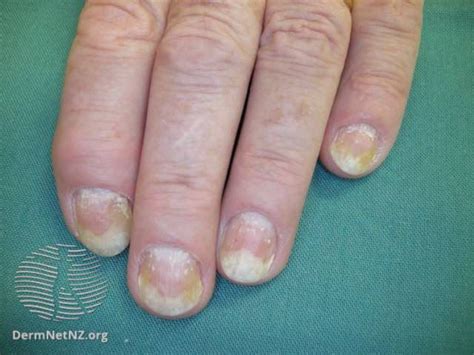 Onycholysis