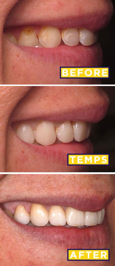 Composite Veneers Before And After