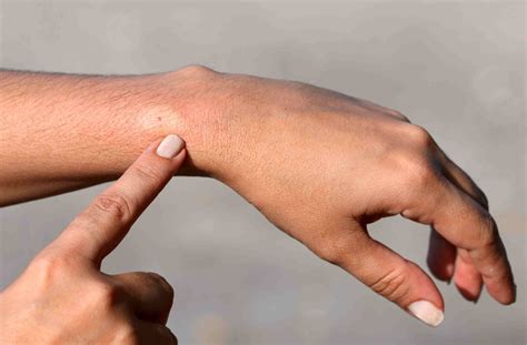 How to Treat a Bee Sting Safely