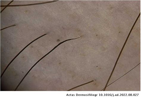 [Translated article] Trichoscopy in Alopecia Areata | Actas Dermo ...