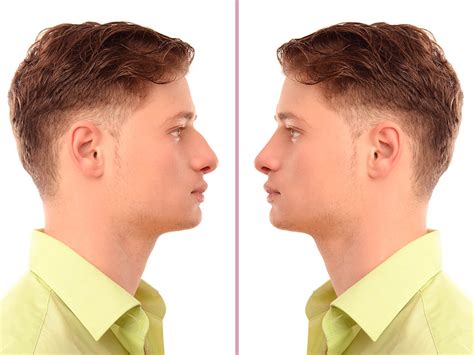 Rinoplastia Masculina Antes E Depois