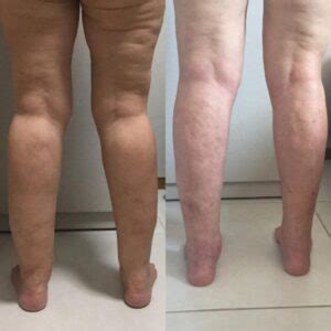 Lipo Lipedema Antes E Depois - Lipedema: Antes e depois em 20 Fotos – Antes da Fama