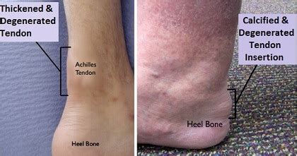 Lump On Heel Of Foot: Causes & Treatment Of Heel Bumps