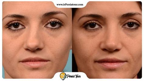 Bony and fleshy nose | Which one’s result is better? | Nose surgery ...