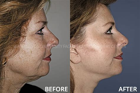 Facelift | Facial Plastic Surgery Center | Washington University in St ...