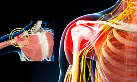 Shoulder impingement syndrome - Osteo Health – osteopath clinic in Calgary