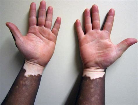 vitiligo dermatology medbullets step