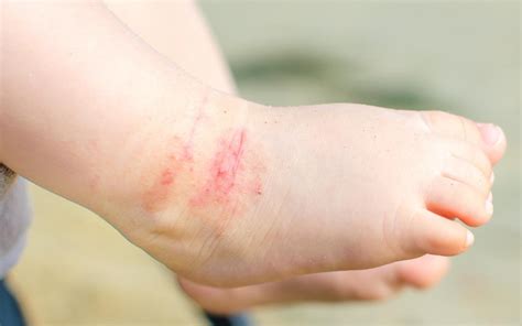 Eczema On Toddlers Feet | Pre School Plan