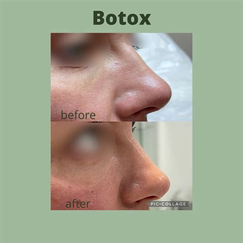 Natural enhancement on the nose with botox Face Laser, Botox Before And ...