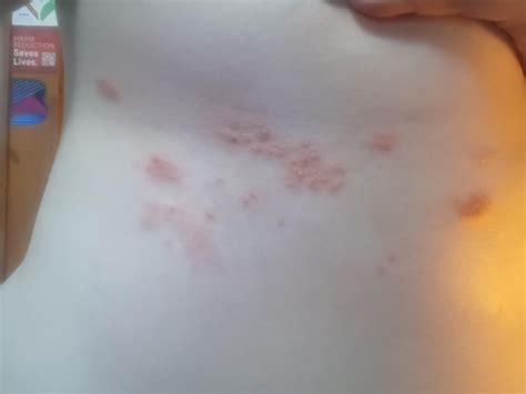 Shingles vs. Heat Rash : r/DermatologyQuestions