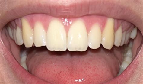 Exposed canine teeth - gum recession? : r/askdentists