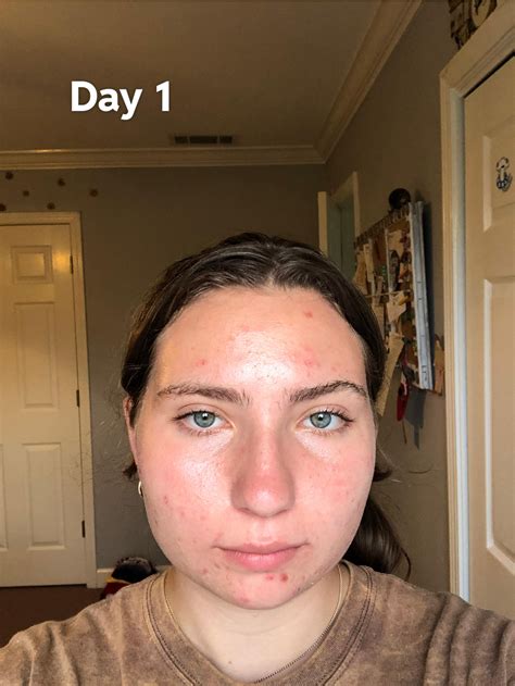 Accutane before and after : r/Accutane