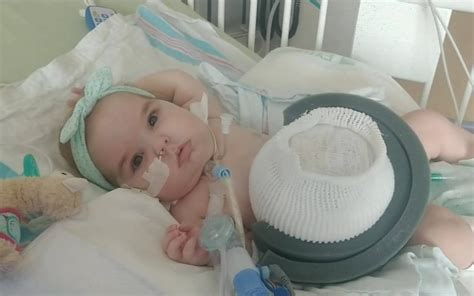 Treatment For A Giant Omphalocele: Everly's Story