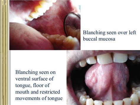 ORAL SUBMUCOUS FIBROSIS- PPT