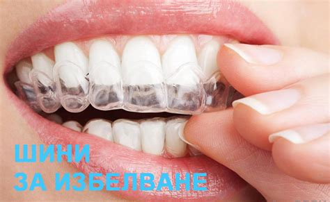 Шини за избелване - Online Dental