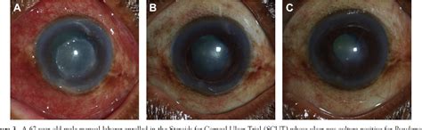 herpes zoster ophthalmicus semantic scholar
