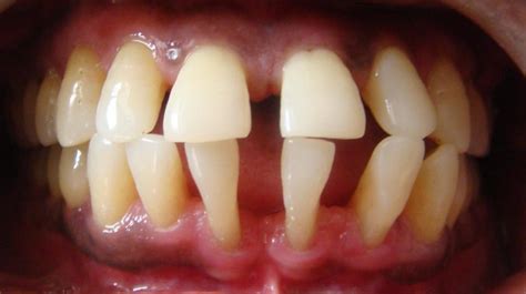 A Shaky Tooth and It's Treatment