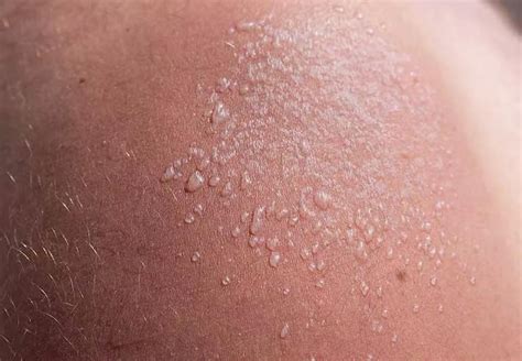 doctor   sunburn