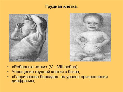 Рахит. Спазмофилия. Гипервитаминоз Д - презентация онлайн