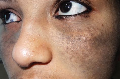 scleral nevus nevus  ota   meningeal melanosis