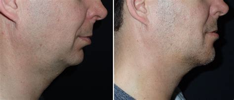 Genioplasty Richmond VA | Chin Implant | Chin Augmentation Midlothian