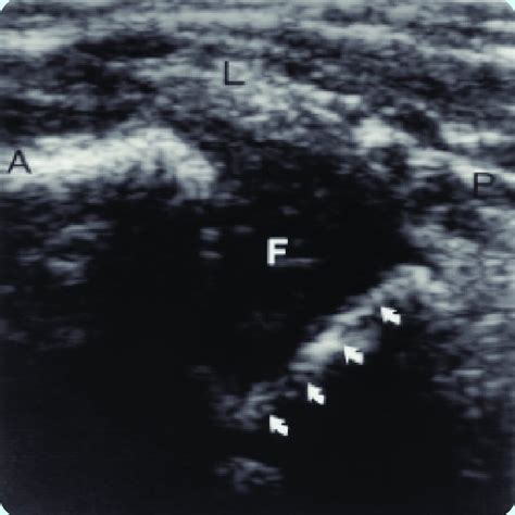 (PDF) Pediatric hip dysplasia and evaluation with ultrasound