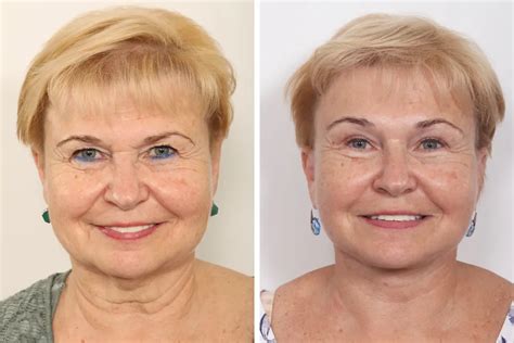 Facelift Before and After Photos | Dr. Benjamin Paul