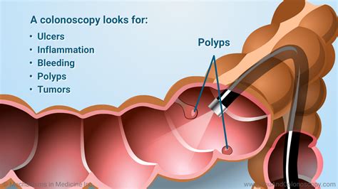 What is a colonoscopy and how do I prepare for it?