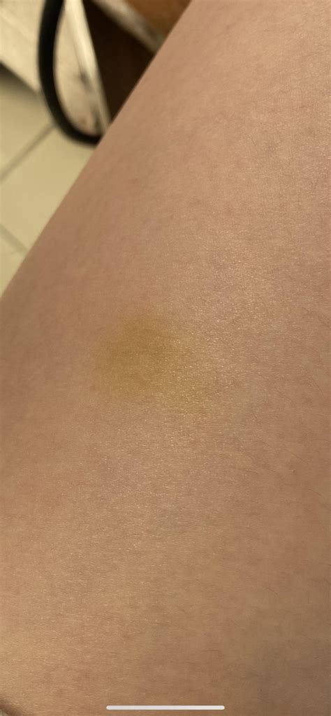 yellow spots  skin jaundice