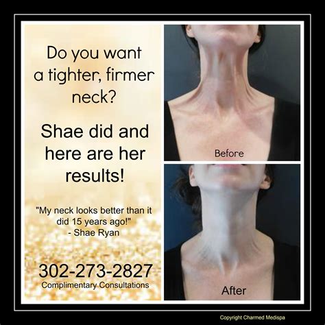 Platysmal Bands and Neck Tightening – Charmed Medispa