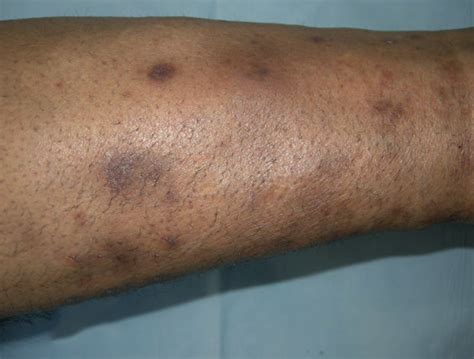 Diabetic Rash On Shins – NBKomputer