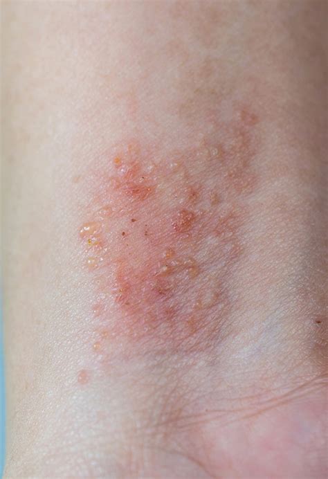 Atopijski dermatitis - Klinika.ba