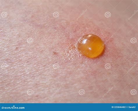 Insect Bite on Skin with Blister. Stock Photo - Image of dermatology ...