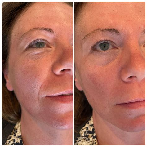 how to eliminate nasolabial folds 4