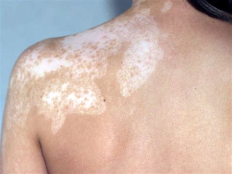 tache blanche peau vitiligo