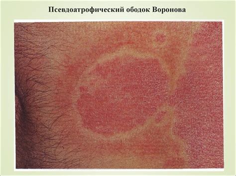 Псориаз. Эпидемиология. Вульгарный, экссудативный, пустулезный псориаз ...