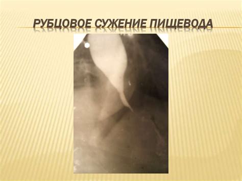 Заболевания пищевода - презентация онлайн