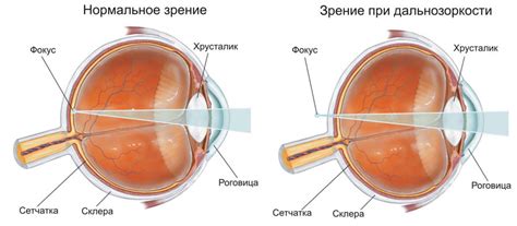 Зрение плюс 1, 2, 3 - что это, симптомы гиперметропии