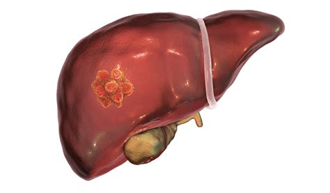 study finds folfirinox   tolerated potentially effective    treatment