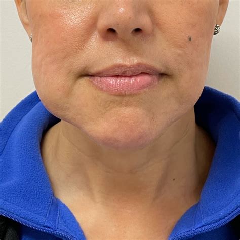 Kybella Double-Chin Treatment in Redondo Beach, CA — Beauty Cult