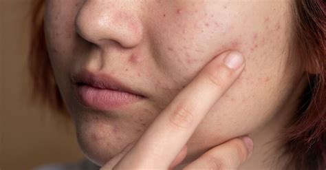 Чем убрать покраснение после прыщей – какие натуральные средства ...
