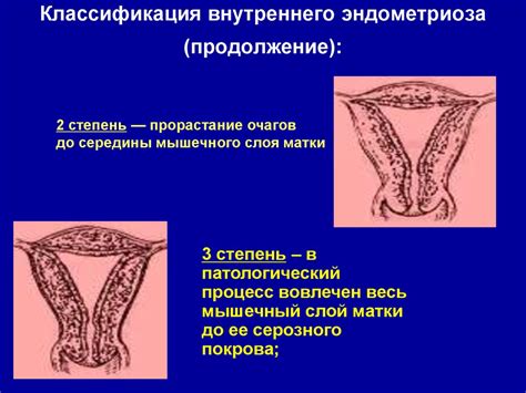 Эндометриоз - презентация онлайн