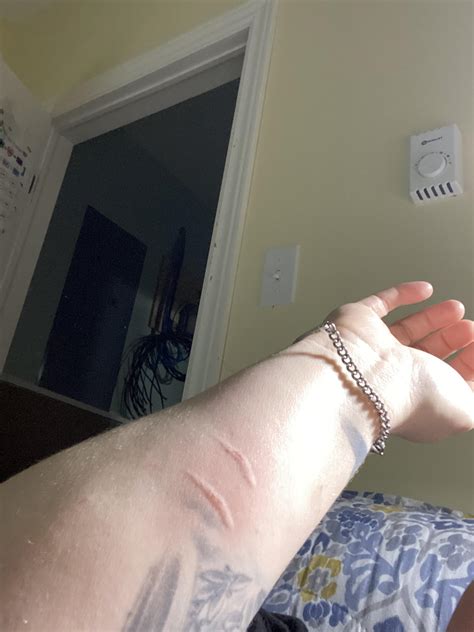 Is it normal for cat bites and scratches to get puffy and/or