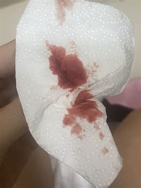 Pregnancy Bleeding Images Girls