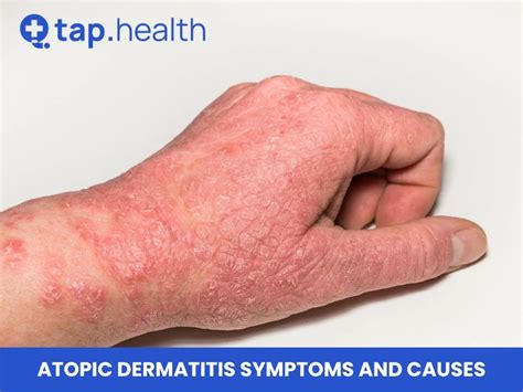 Atopic Dermatitis Symptoms and Causes - Tap Health