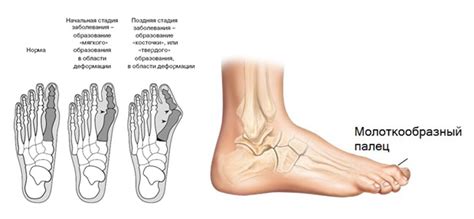 Плоскостопие – Медицинская клиника Панацея в Домодедово